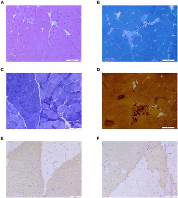 Charcot–Marie–Tooth Disease With Episodic Rhabdomyolysis Due to Two Novel Mutations in the β Subunit of Mitochondrial Trifunctional Protein and Effective Response to Modified Diet Therapy